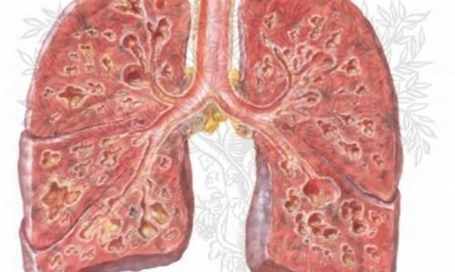 Xơ phổi ảnh hưởng đến sức khỏe như thế nào?