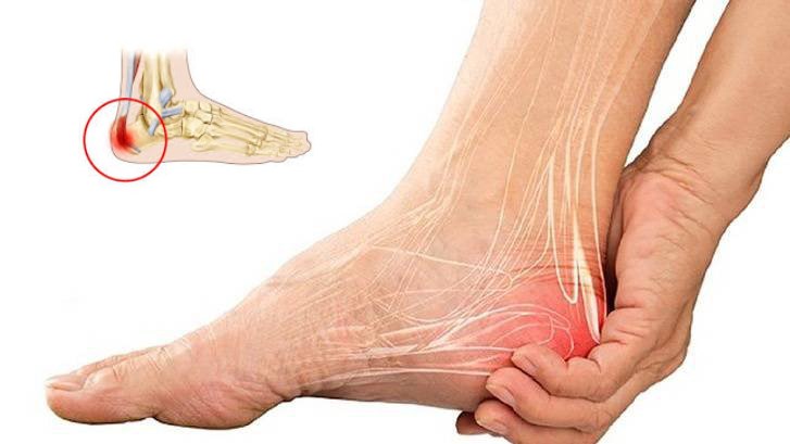 Biểu hiện điển hình khi mắc gai gót chân, đừng chủ quan với những cơn đau ở bàn chân
