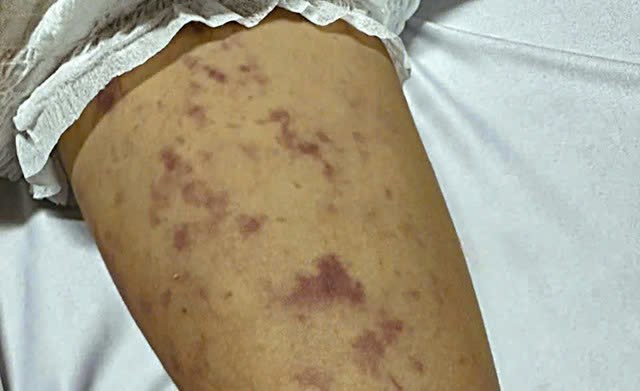 Từ cơn sốt nhẹ đến giây phút sinh tử - 24 giờ mong manh của con trước bệnh do não mô cầu